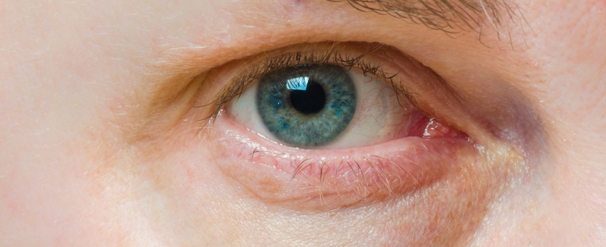 treatments to help dry eye syndrome